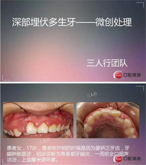 深部埋伏多生牙&mdash;&mdash;微創(chuàng)處理  