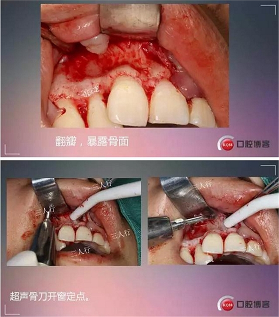 深部埋伏多生牙&mdash;&mdash;微創(chuàng)處理  