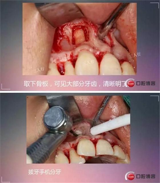 深部埋伏多生牙&mdash;&mdash;微創(chuàng)處理  