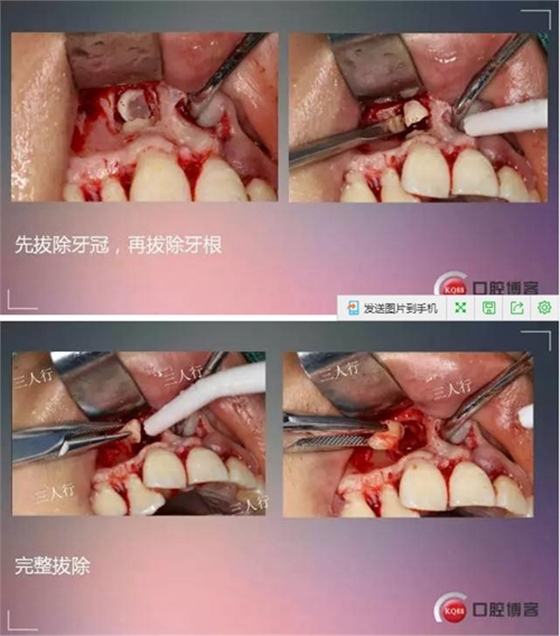 深部埋伏多生牙&mdash;&mdash;微創(chuàng)處理  