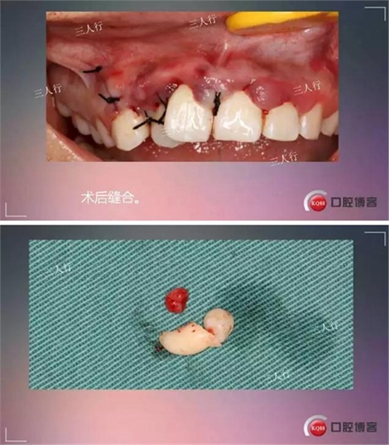 深部埋伏多生牙&mdash;&mdash;微創(chuàng)處理  