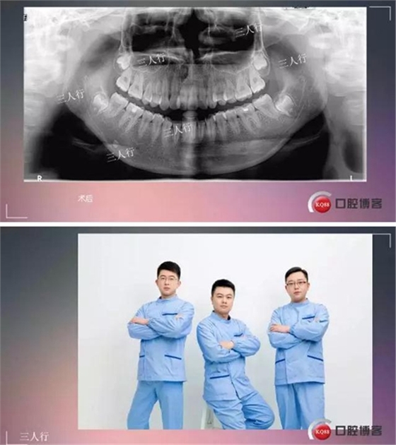 深部埋伏多生牙&mdash;&mdash;微創(chuàng)處理  