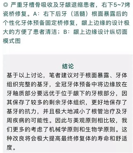 做全冠修復時基牙根面暴露，如何備牙？