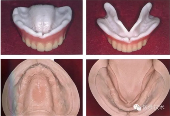 全口拔牙即戴全口活動(dòng)義齒修復(fù)病例 