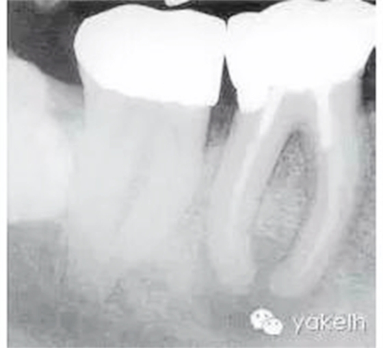 根管治療后根尖周炎(繼發(fā)感染) 科貿(mào)嘉友收錄 根管治療后根尖周炎(繼發(fā)感染) 科貿(mào)嘉友收錄