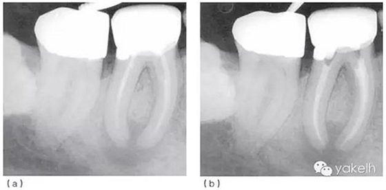 根管治療后根尖周炎(繼發(fā)感染) 根管治療后根尖周炎(繼發(fā)感染)
