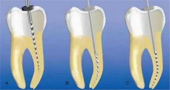 彎曲根管預(yù)備的方法和技巧 彎曲根管預(yù)備的方法和技巧