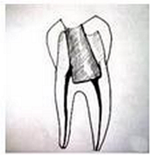 彎曲根管預(yù)備的方法和技巧 彎曲根管預(yù)備的方法和技巧