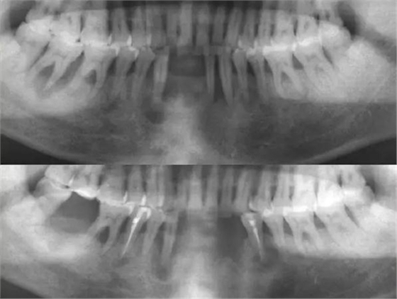 根管治療失敗原因的臨床分析 根管治療失敗原因的臨床分析