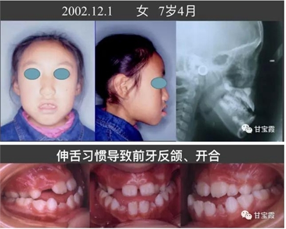 口腔不良習(xí)慣會引起牙頜畸形 口腔不良習(xí)慣會引起牙頜畸形