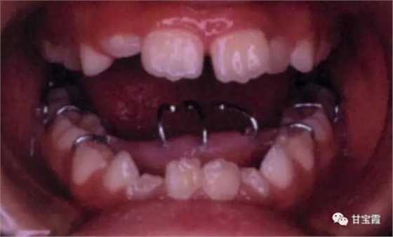 口腔不良習(xí)慣會引起牙頜畸形 口腔不良習(xí)慣會引起牙頜畸形