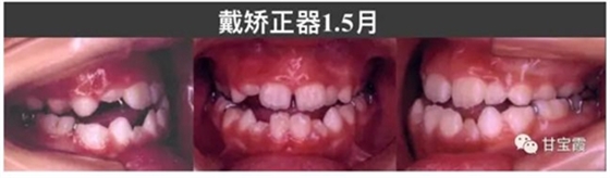 口腔不良習(xí)慣會引起牙頜畸形 口腔不良習(xí)慣會引起牙頜畸形