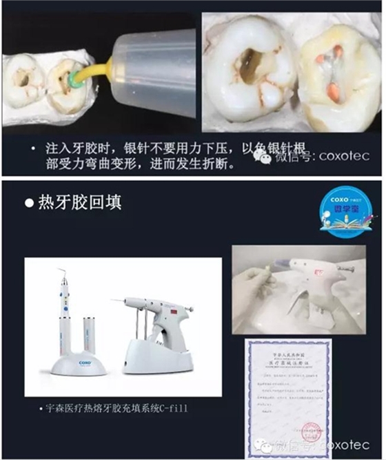 熱牙膠根管填充常見問題解答 熱牙膠根管填充常見問題解答