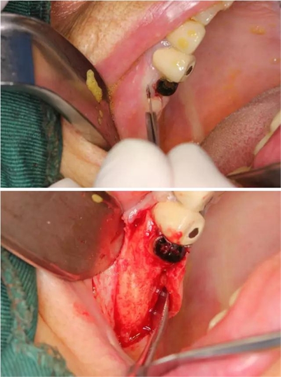 牙周病患者的外提升 牙周病患者的外提升