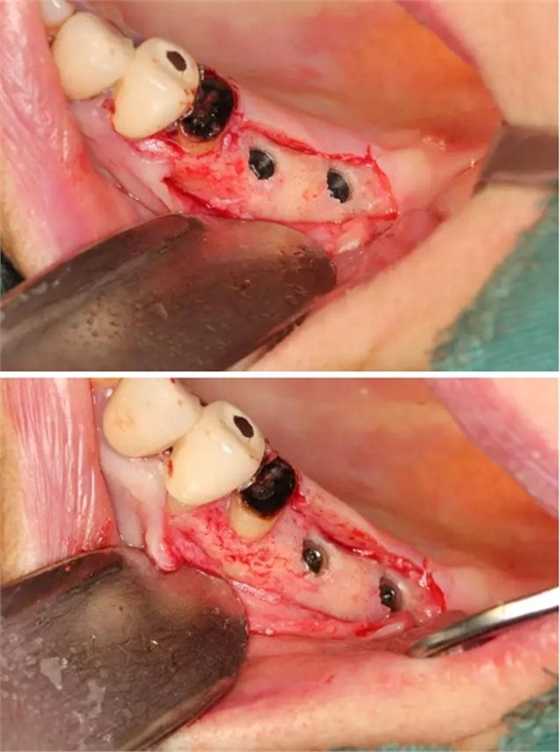 牙周病患者的外提升 牙周病患者的外提升