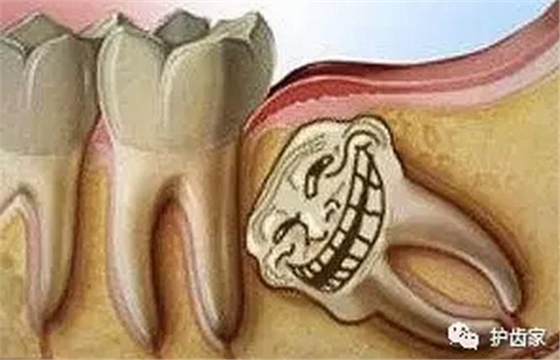 智齒一定要拔嗎? 智齒一定要拔嗎?