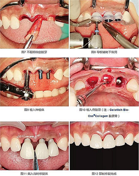 上頜多顆相鄰前牙的“精確化”即刻種植修復 上頜多顆相鄰前牙的“精確化”即刻種植修復