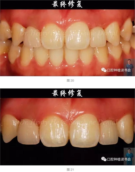 2017口腔醫(yī)師口腔組織病理之牙齦病 2017口腔醫(yī)師口腔組織病理之牙齦病