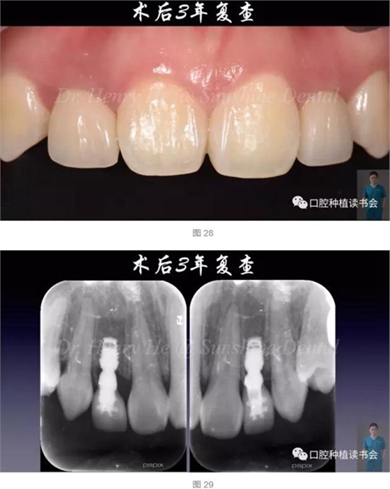 2017口腔醫(yī)師口腔組織病理之牙齦病 2017口腔醫(yī)師口腔組織病理之牙齦病