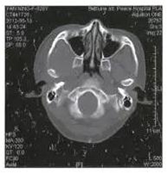 少見部位的下頜骨骨髓炎4例 少見部位的下頜骨骨髓炎4例