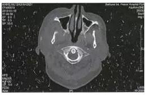 少見部位的下頜骨骨髓炎4例 少見部位的下頜骨骨髓炎4例