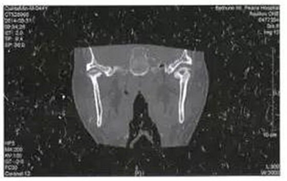 少見部位的下頜骨骨髓炎4例 少見部位的下頜骨骨髓炎4例