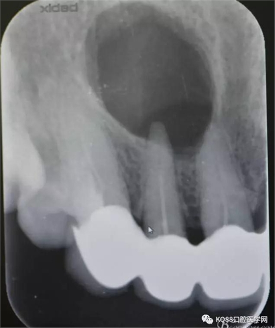 上頜側(cè)切牙根尖手術(shù)&mdash;&mdash;張東星  
