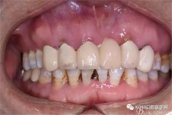 上頜側(cè)切牙根尖手術(shù)&mdash;&mdash;張東星  