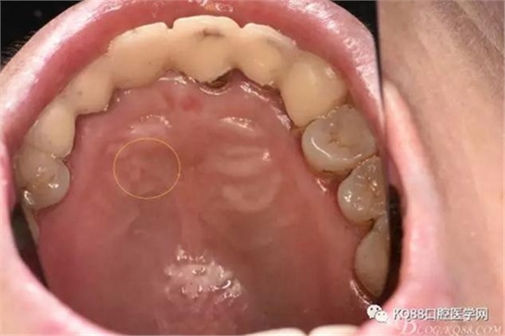 上頜側(cè)切牙根尖手術(shù)&mdash;&mdash;張東星  