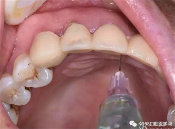 上頜側(cè)切牙根尖手術(shù)&mdash;&mdash;張東星  