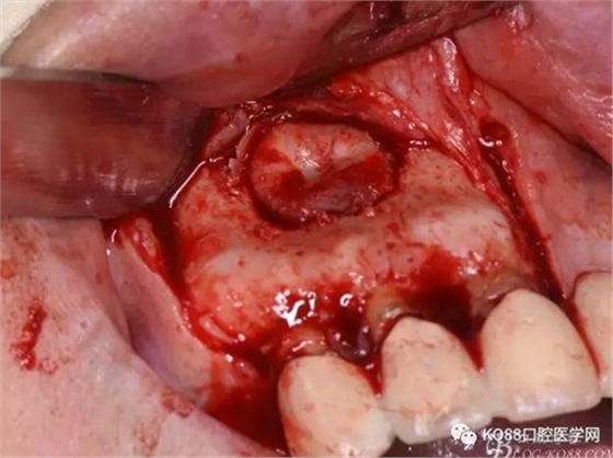 上頜側(cè)切牙根尖手術(shù)&mdash;&mdash;張東星  