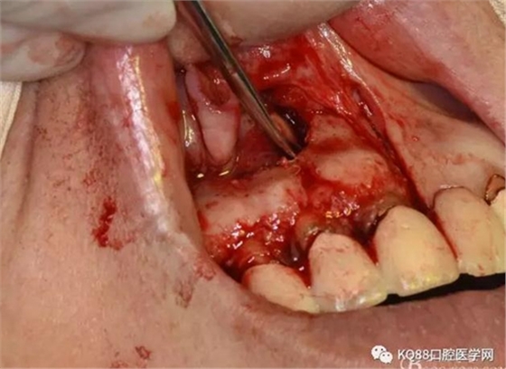 上頜側(cè)切牙根尖手術(shù)&mdash;&mdash;張東星  