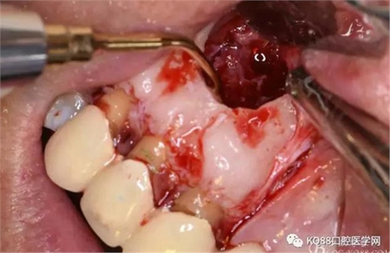 上頜側(cè)切牙根尖手術(shù)&mdash;&mdash;張東星  