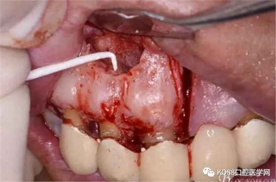 上頜側(cè)切牙根尖手術(shù)&mdash;&mdash;張東星  