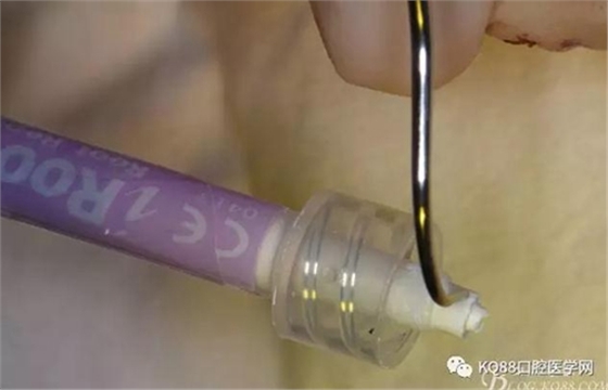 上頜側(cè)切牙根尖手術(shù)&mdash;&mdash;張東星  