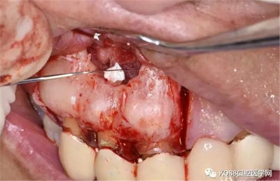 上頜側(cè)切牙根尖手術(shù)&mdash;&mdash;張東星  