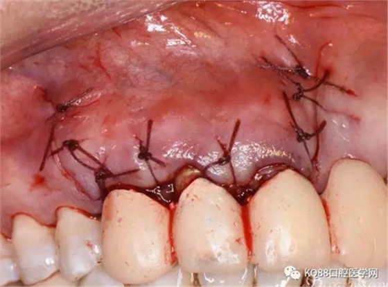 上頜側(cè)切牙根尖手術(shù)&mdash;&mdash;張東星  