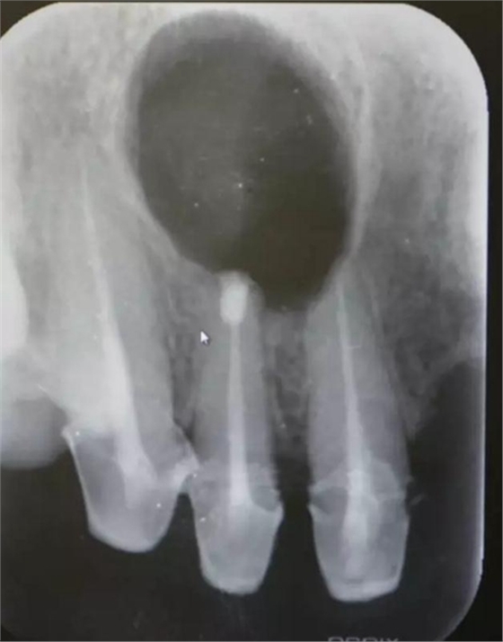 上頜側(cè)切牙根尖手術(shù)&mdash;&mdash;張東星  