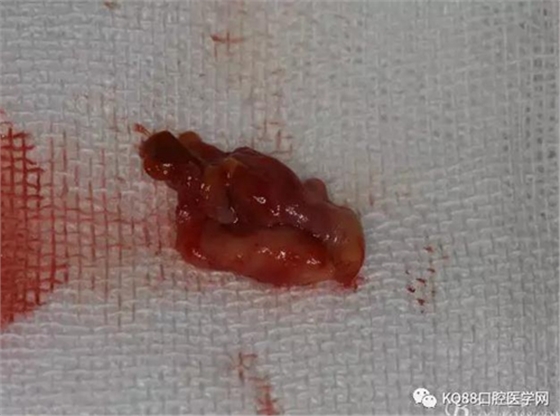 上頜側(cè)切牙根尖手術(shù)&mdash;&mdash;張東星  