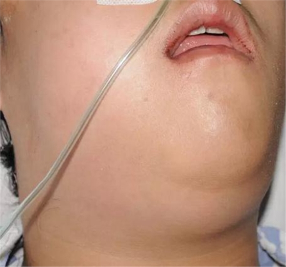 警惕！牙疼引發(fā)的間隙感染很危險