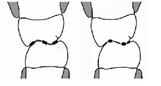 凸凹式后牙咬合接觸及其臨床意義&mdash;&mdash;王美青教授