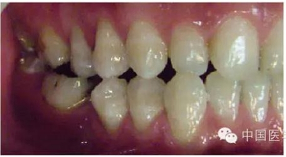 凸凹式后牙咬合接觸及其臨床意義&mdash;&mdash;王美青教授