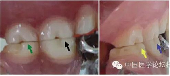 凸凹式后牙咬合接觸及其臨床意義&mdash;&mdash;王美青教授