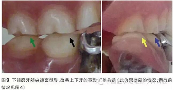 凸凹式后牙咬合接觸及其臨床意義&mdash;&mdash;王美青教授