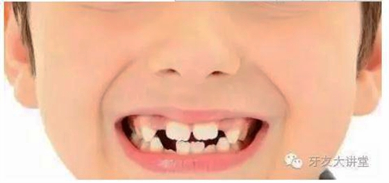 12歲前必須處理的20種兒童牙頜畸形【口腔科普】