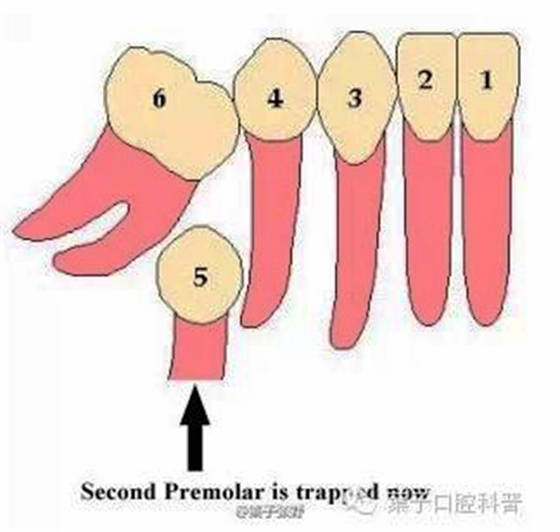 乳牙缺失致恒牙&ldquo;亂長&rdquo;，這個&ldquo;間隙保持器&rdquo;可預防