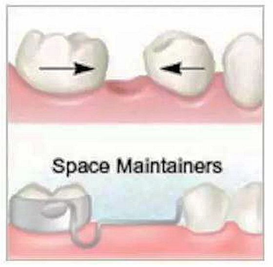 乳牙缺失致恒牙&ldquo;亂長&rdquo;，這個&ldquo;間隙保持器&rdquo;可預防