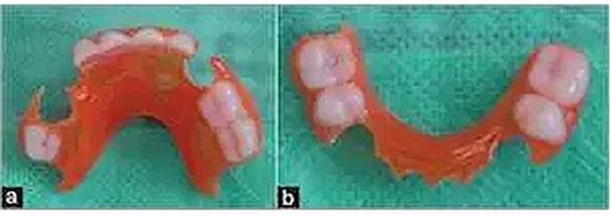 乳牙缺失致恒牙&ldquo;亂長&rdquo;，這個&ldquo;間隙保持器&rdquo;可預防