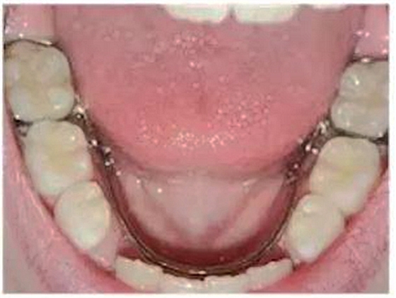 乳牙缺失致恒牙&ldquo;亂長&rdquo;，這個&ldquo;間隙保持器&rdquo;可預防