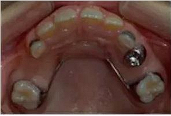 乳牙缺失致恒牙&ldquo;亂長&rdquo;，這個&ldquo;間隙保持器&rdquo;可預防